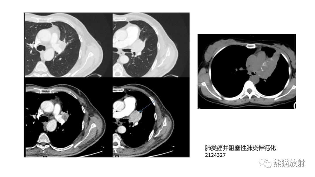 影像PPT - 【病例】肺原位腺癌 VS 浸润性腺癌-33