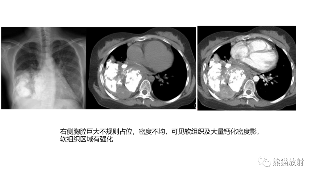 影像PPT - 【病例】肺原位腺癌 VS 浸润性腺癌-37