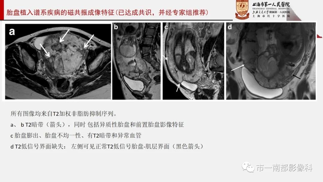 影像PPT - 【PPT】SAR和ESUR关于胎盘植入MR影像诊断联合共识-11