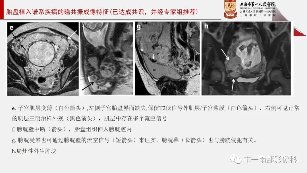 影像PPT - 【PPT】SAR和ESUR关于胎盘植入MR影像诊断联合共识-12