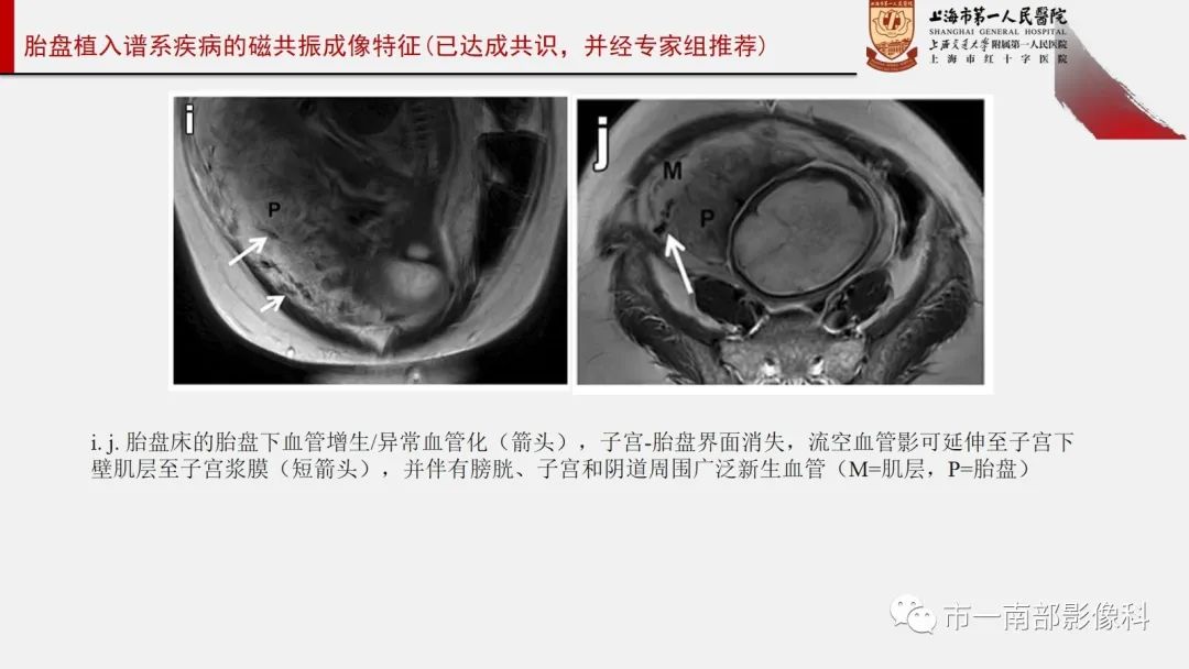 影像PPT - 【PPT】SAR和ESUR关于胎盘植入MR影像诊断联合共识-13
