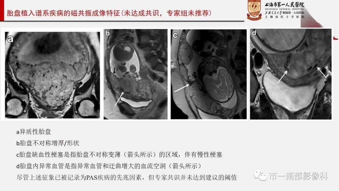 影像PPT - 【PPT】SAR和ESUR关于胎盘植入MR影像诊断联合共识-14