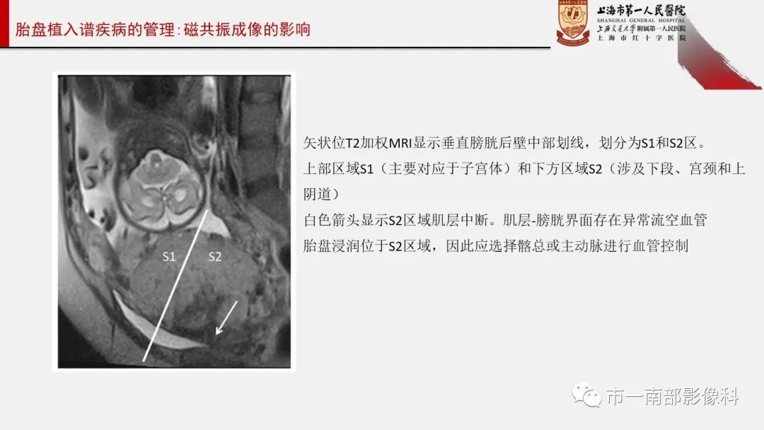 影像PPT - 【PPT】SAR和ESUR关于胎盘植入MR影像诊断联合共识-17