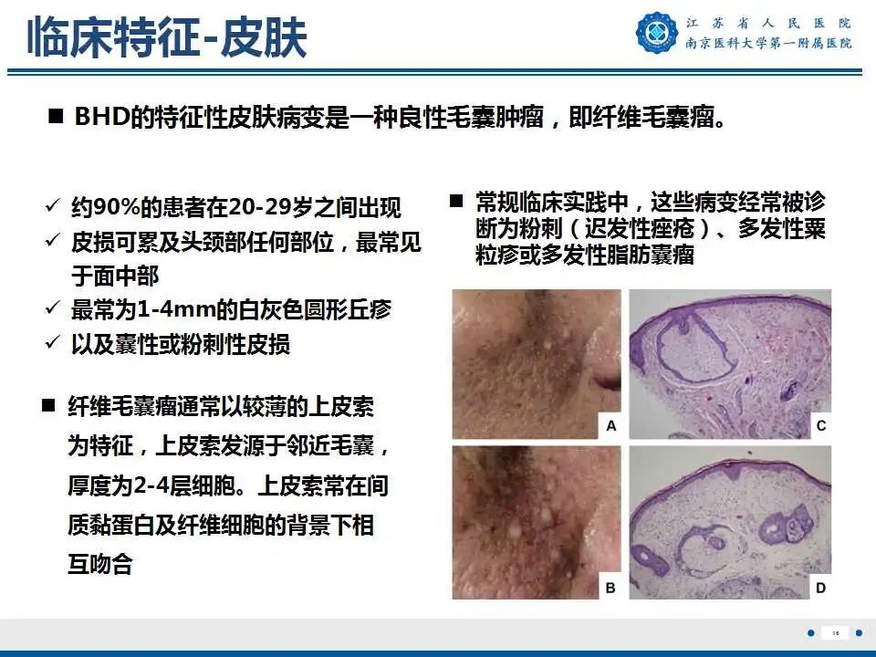 影像PPT - 【PPT】Birt-Hogg-Dubé综合征-17
