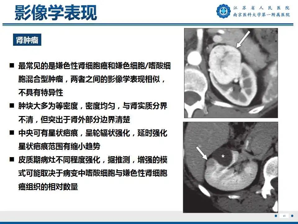 影像PPT - 【PPT】Birt-Hogg-Dubé综合征-24