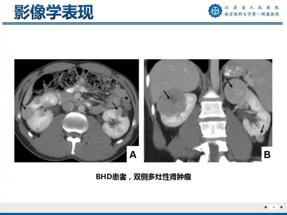 影像PPT - 【PPT】Birt-Hogg-Dubé综合征-25
