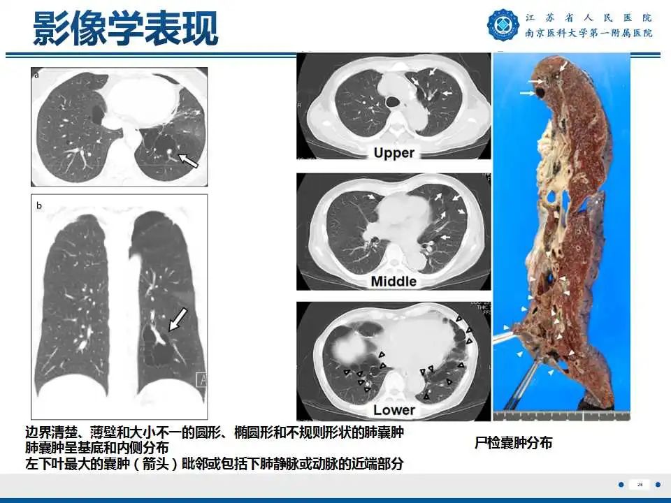 影像PPT - 【PPT】Birt-Hogg-Dubé综合征-27