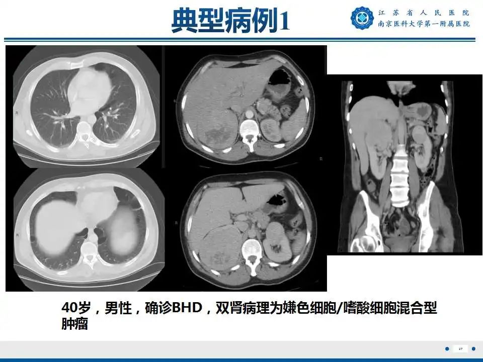 影像PPT - 【PPT】Birt-Hogg-Dubé综合征-28