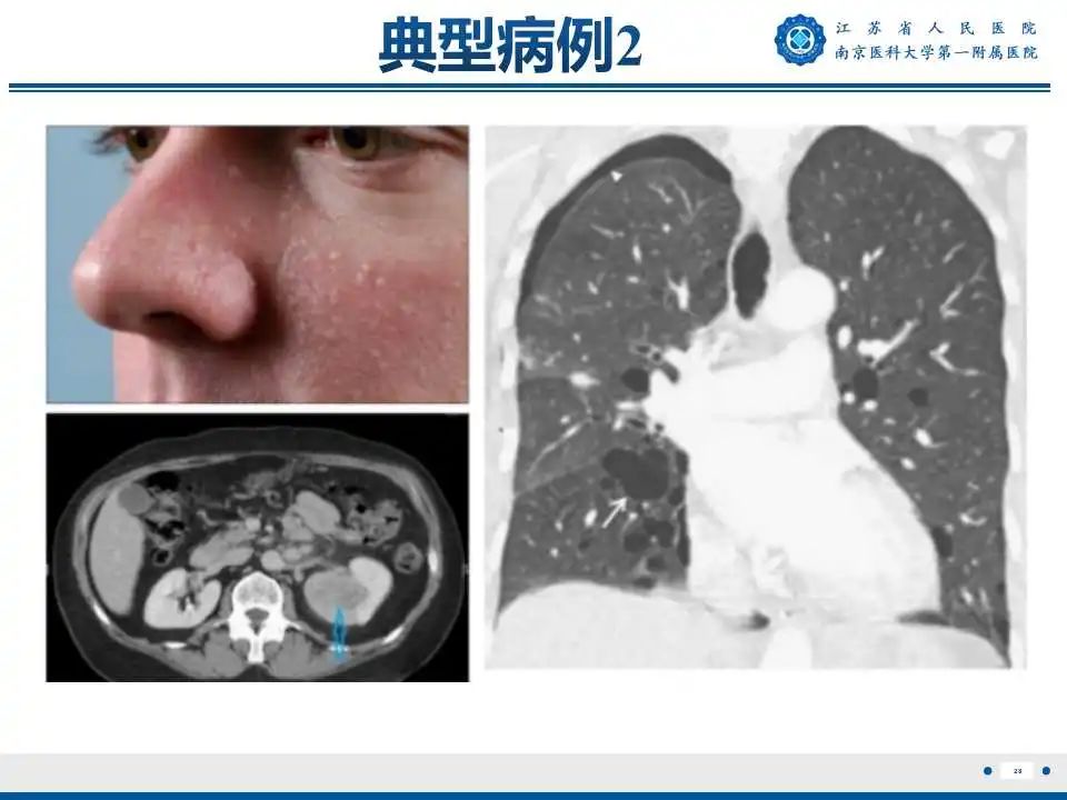 影像PPT - 【PPT】Birt-Hogg-Dubé综合征-29
