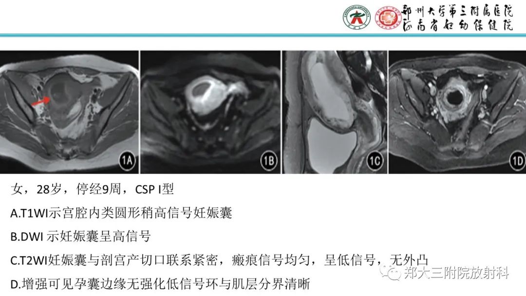 影像PPT - 【PPT】瘢痕妊娠的影像学表现-7