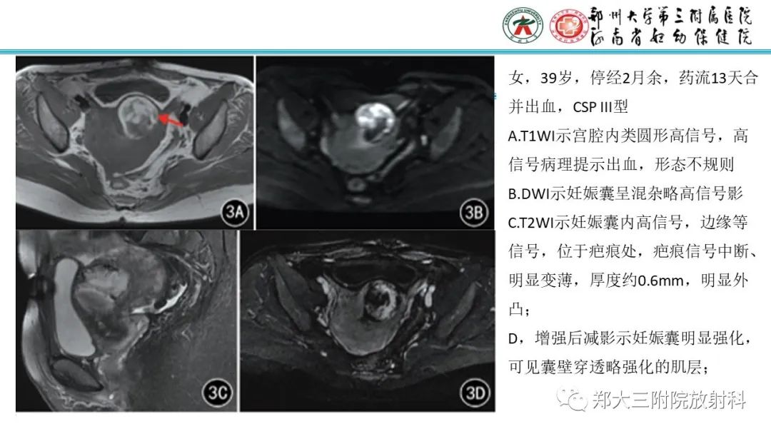 影像PPT - 【PPT】瘢痕妊娠的影像学表现-9