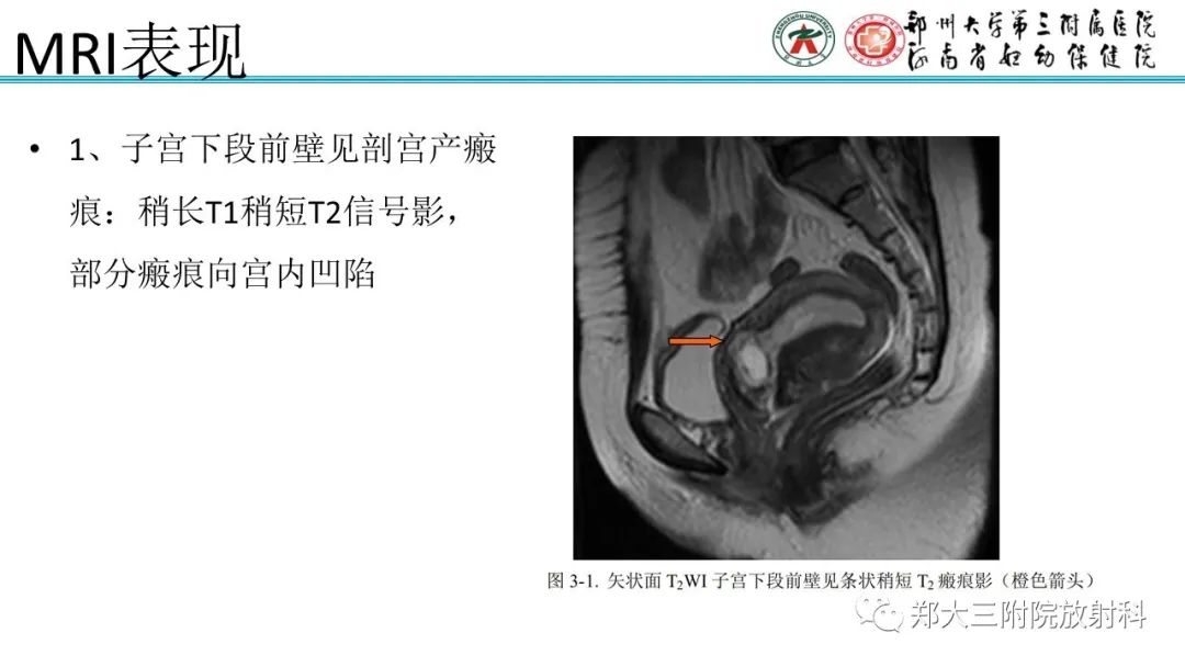 影像PPT - 【PPT】瘢痕妊娠的影像学表现-13