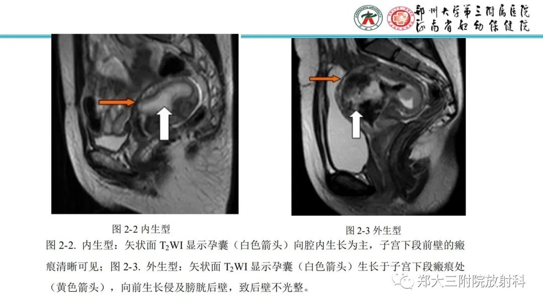 影像PPT - 【PPT】瘢痕妊娠的影像学表现-11