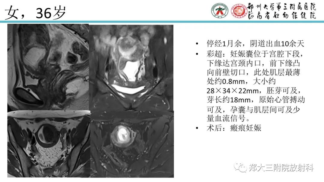 影像PPT - 【PPT】瘢痕妊娠的影像学表现-19