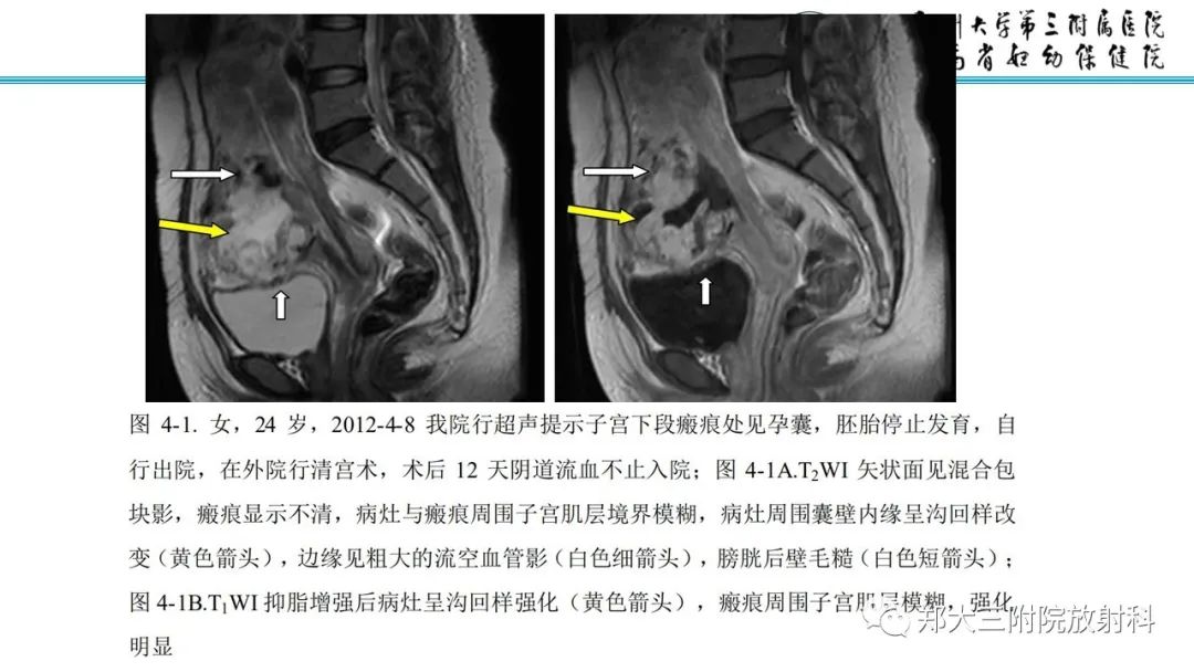 影像PPT - 【PPT】瘢痕妊娠的影像学表现-21