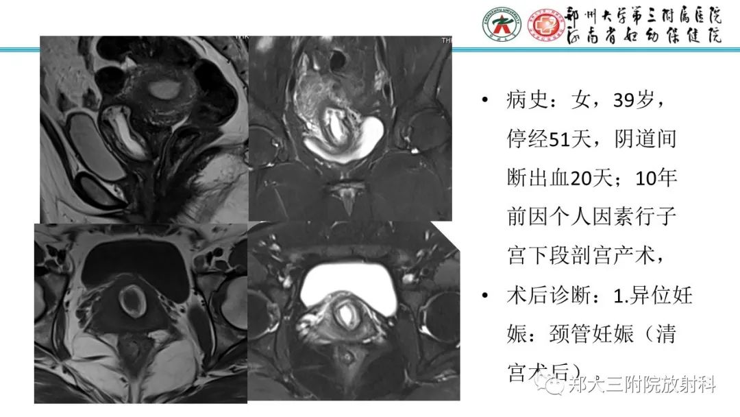 影像PPT - 【PPT】瘢痕妊娠的影像学表现-23