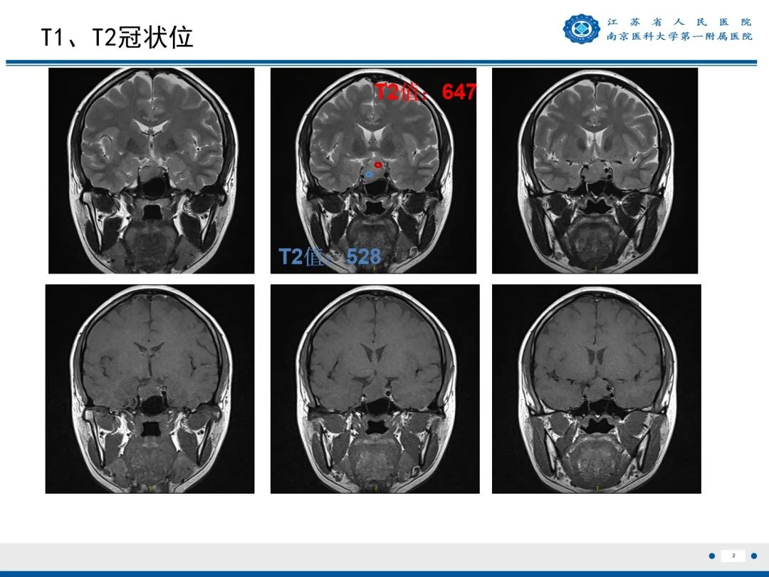 影像PPT - 【PPT】垂体腺瘤-3