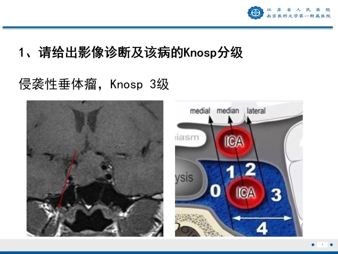 影像PPT - 【PPT】垂体腺瘤-8