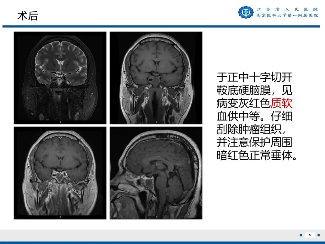 影像PPT - 【PPT】垂体腺瘤-13