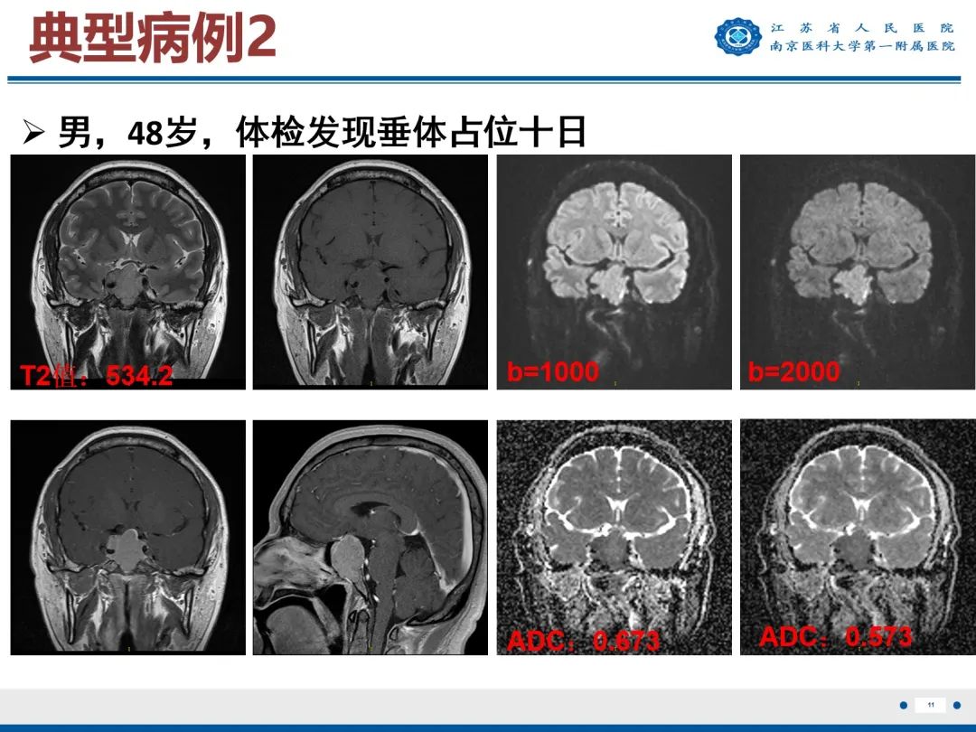 影像PPT - 【PPT】垂体腺瘤-12
