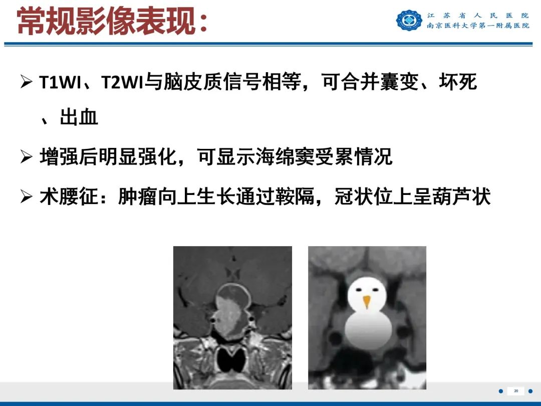 影像PPT - 【PPT】垂体腺瘤-21