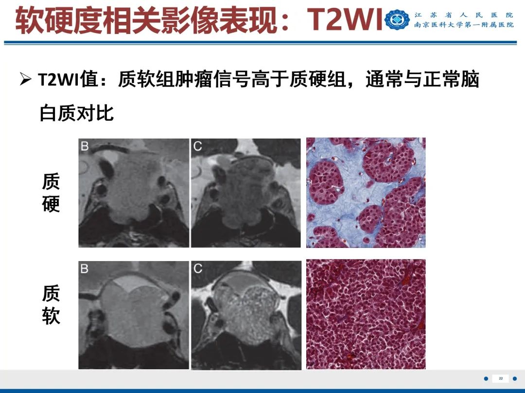 影像PPT - 【PPT】垂体腺瘤-23