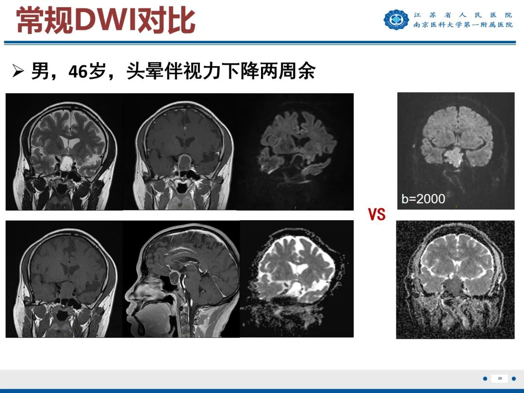 影像PPT - 【PPT】垂体腺瘤-30