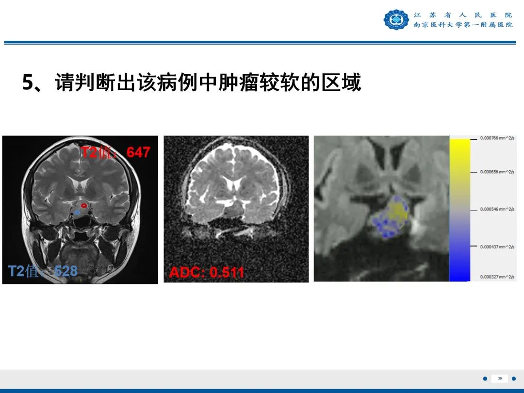 影像PPT - 【PPT】垂体腺瘤-31