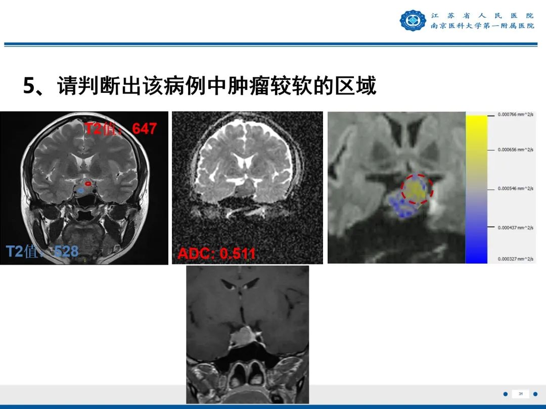 影像PPT - 【PPT】垂体腺瘤-32