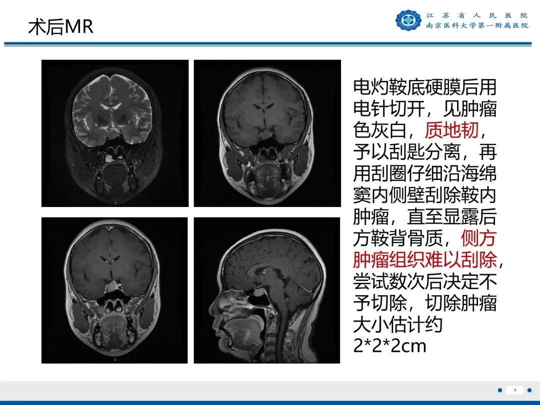 影像PPT - 【PPT】垂体腺瘤-2