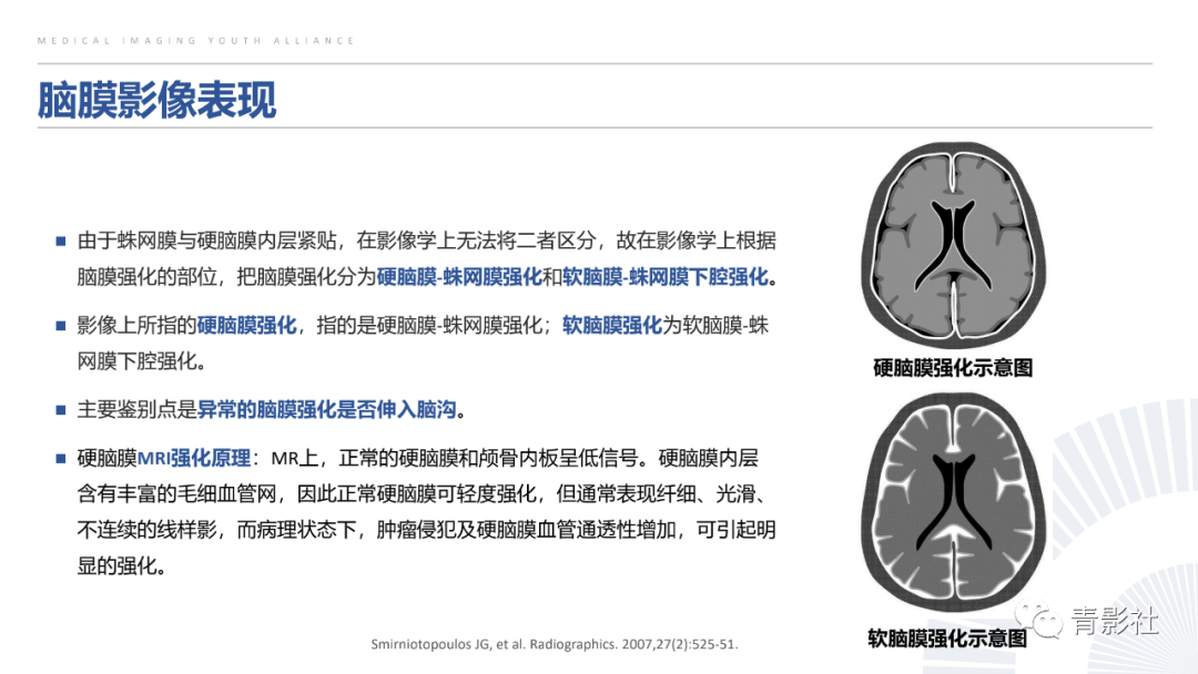 影像PPT - 【PPT】颅脑硬膜尾征：beyond meningioma-5