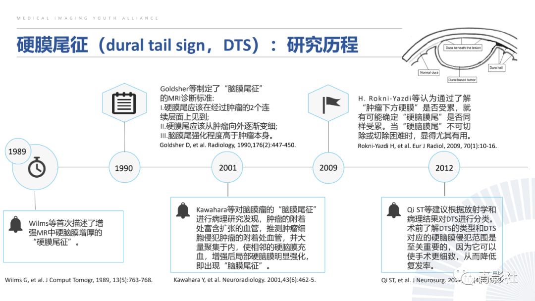 影像PPT - 【PPT】颅脑硬膜尾征：beyond meningioma-6