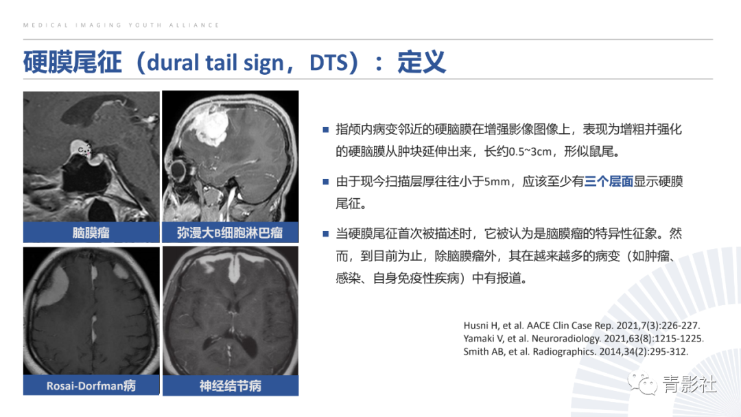 影像PPT - 【PPT】颅脑硬膜尾征：beyond meningioma-7