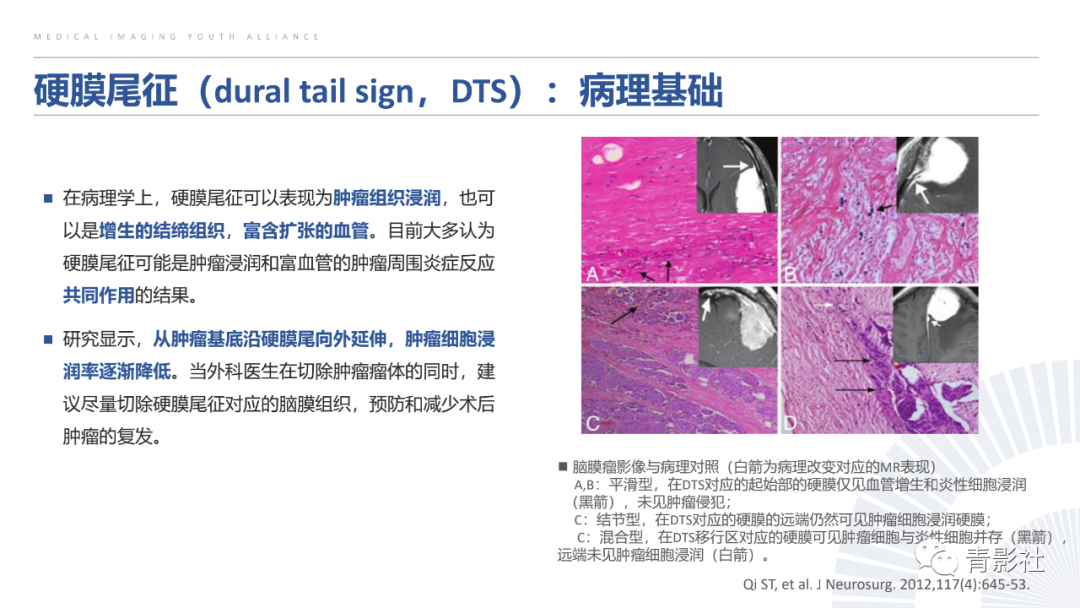 影像PPT - 【PPT】颅脑硬膜尾征：beyond meningioma-8