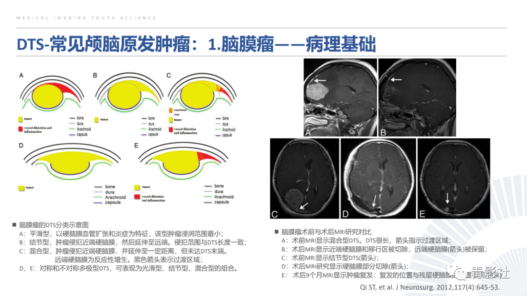 影像PPT - 【PPT】颅脑硬膜尾征：beyond meningioma-13