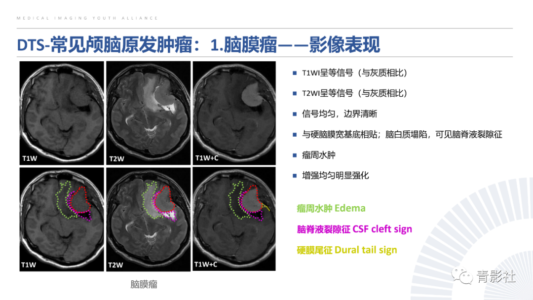 影像PPT - 【PPT】颅脑硬膜尾征：beyond meningioma-15