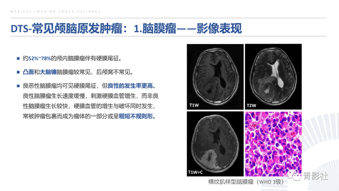 影像PPT - 【PPT】颅脑硬膜尾征：beyond meningioma-16
