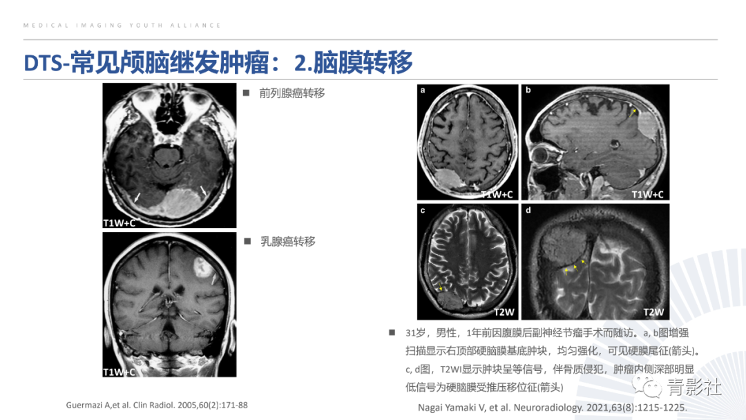 影像PPT - 【PPT】颅脑硬膜尾征：beyond meningioma-18