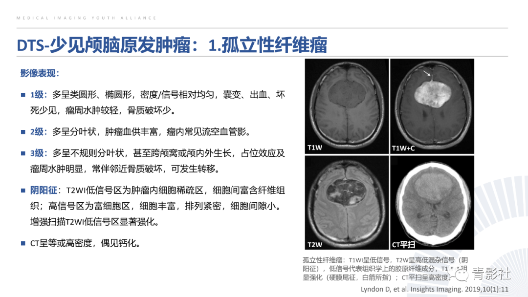 影像PPT - 【PPT】颅脑硬膜尾征：beyond meningioma-21