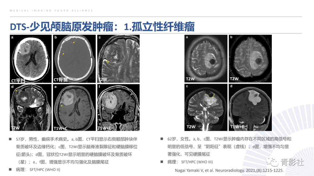 影像PPT - 【PPT】颅脑硬膜尾征：beyond meningioma-22