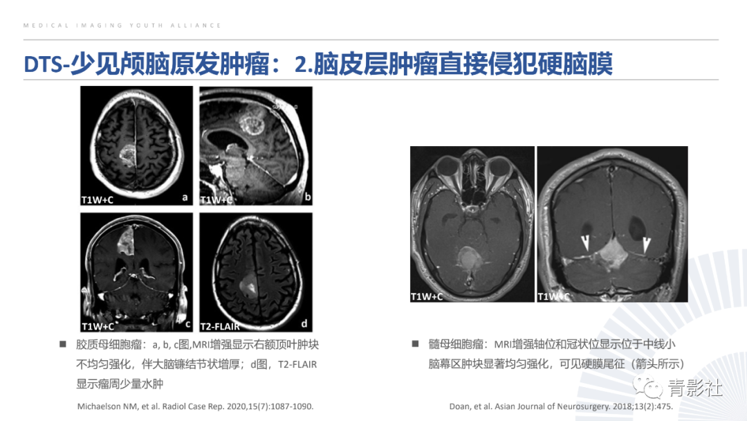 影像PPT - 【PPT】颅脑硬膜尾征：beyond meningioma-25