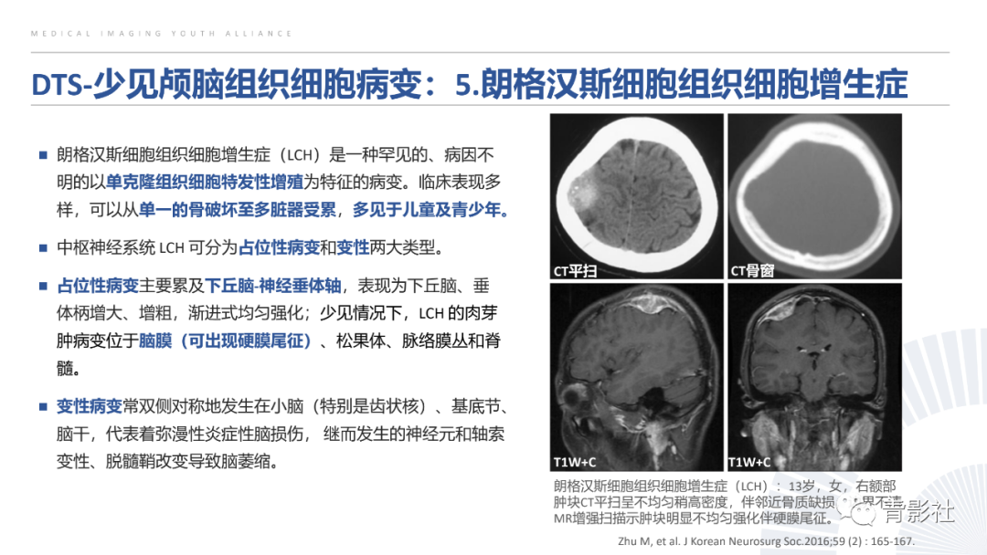 影像PPT - 【PPT】颅脑硬膜尾征：beyond meningioma-29