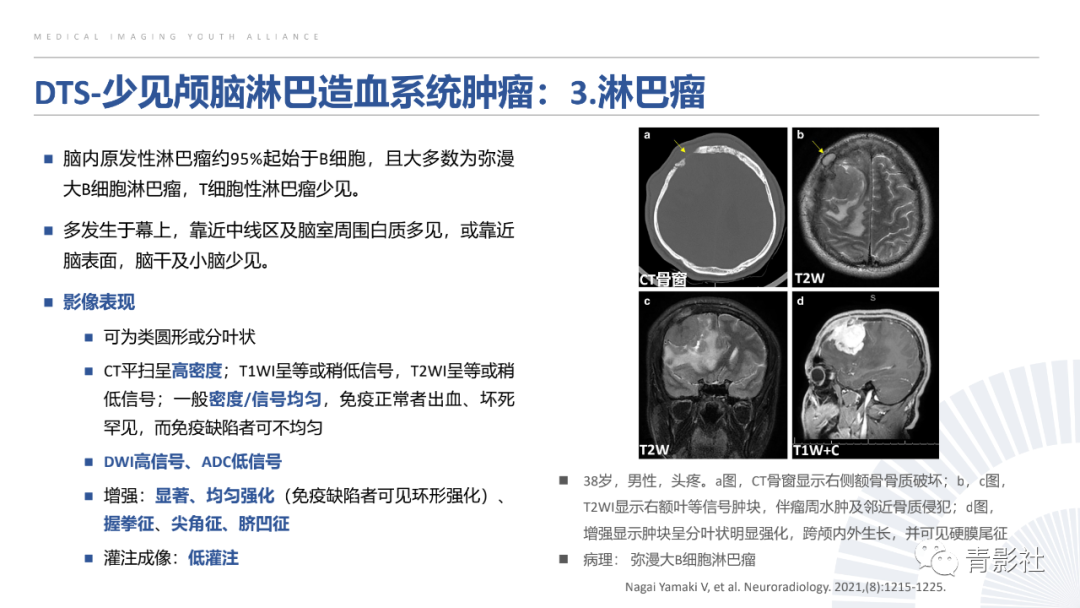 影像PPT - 【PPT】颅脑硬膜尾征：beyond meningioma-26