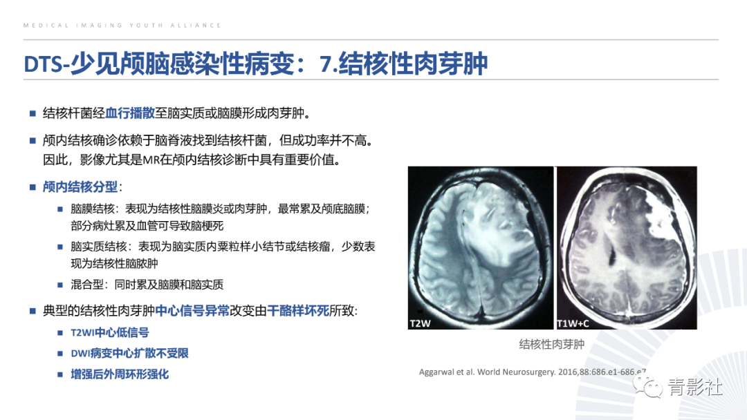 影像PPT - 【PPT】颅脑硬膜尾征：beyond meningioma-31