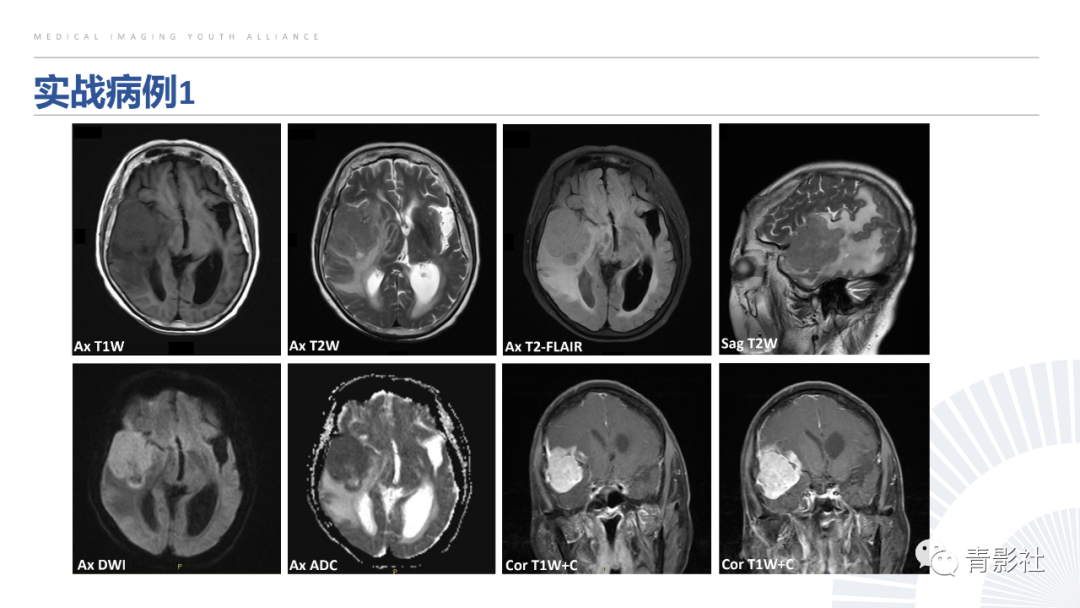 影像PPT - 【PPT】颅脑硬膜尾征：beyond meningioma-47