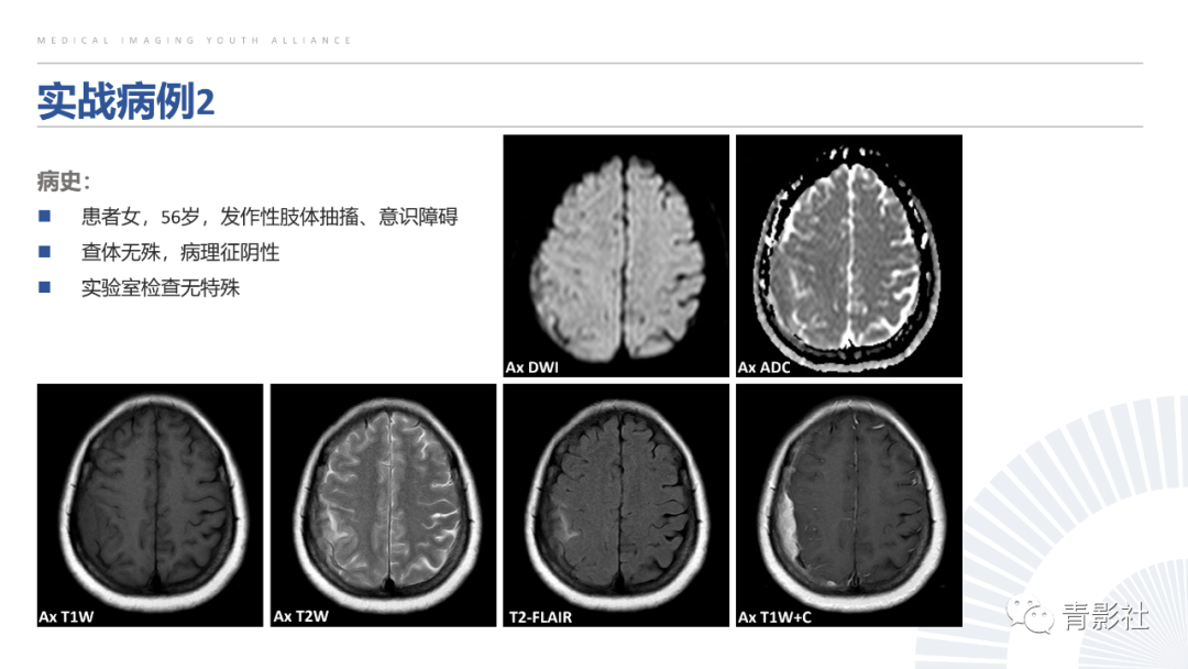 影像PPT - 【PPT】颅脑硬膜尾征：beyond meningioma-52