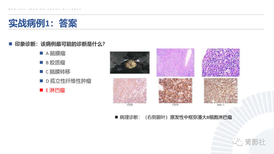 影像PPT - 【PPT】颅脑硬膜尾征：beyond meningioma-51