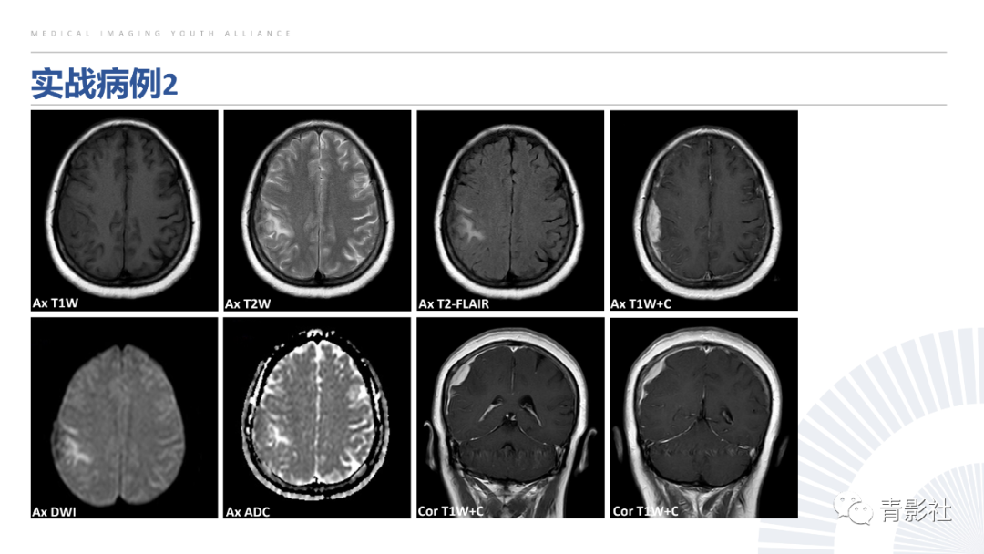 影像PPT - 【PPT】颅脑硬膜尾征：beyond meningioma-53