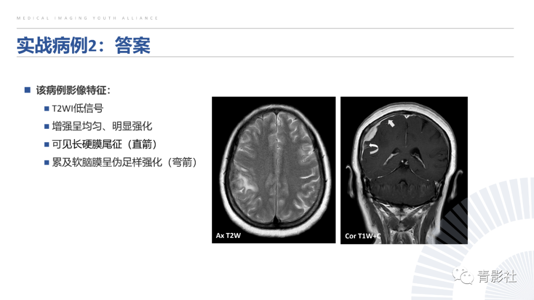 影像PPT - 【PPT】颅脑硬膜尾征：beyond meningioma-55