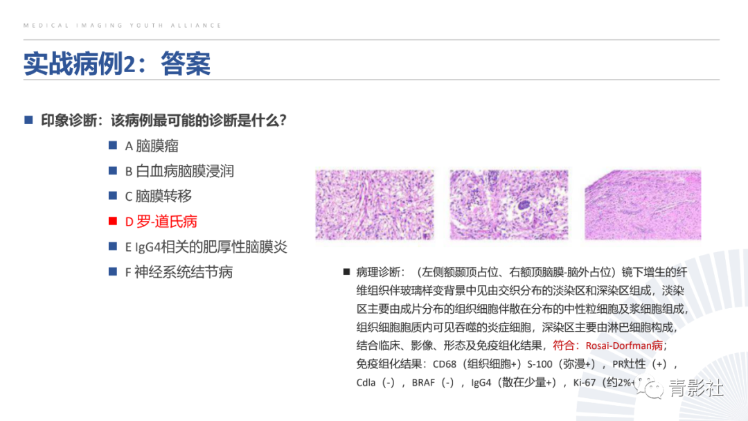 影像PPT - 【PPT】颅脑硬膜尾征：beyond meningioma-56